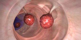 Aktuelle Studie: Softdrinks lassen Darmpolypen wachsen Darmpolypen