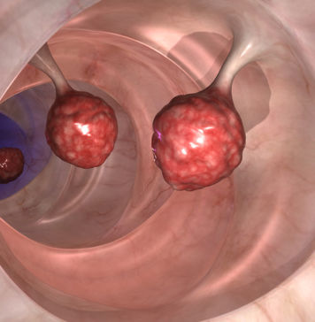 Aktuelle Studie: Softdrinks lassen Darmpolypen wachsen Darmpolypen