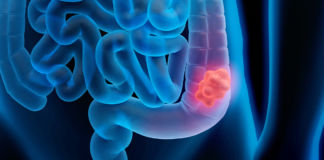 Warum zunehmend junge Menschen an Darmkrebs erkranken Darmkrebs