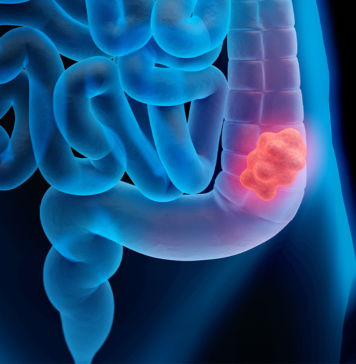 Warum zunehmend junge Menschen an Darmkrebs erkranken Darmkrebs