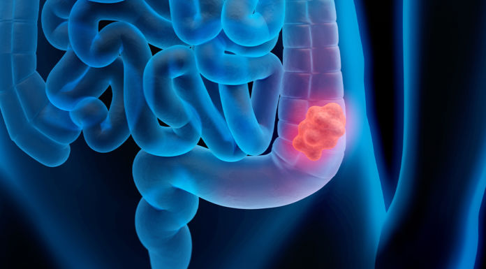 Warum zunehmend junge Menschen an Darmkrebs erkranken Darmkrebs
