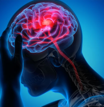 Zahngesundheit und Herz-Kreislauf-Erkrankungen Zahngesundheit und Schlaganfall