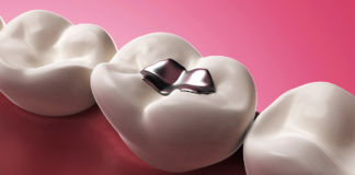 Amalgam – völlig harmlos oder Gefahr für Ihre Gesundheit? Amalgam
