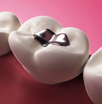 Amalgam – völlig harmlos oder Gefahr für Ihre Gesundheit? Amalgam