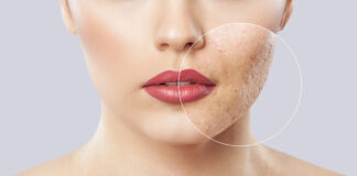 Pickel, Akne, Mitesser: Ursachen und Therapie-Möglichkeiten Pickel