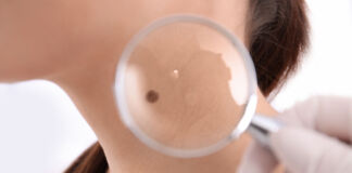 Schwarzer und weißer Hautkrebs / LIVE mit Marcus Stanton – 28.09.2022