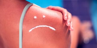 Wie entsteht ein Sonnenbrand?