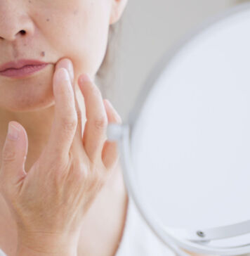 Altersflecken – Werde ich die wieder los?