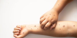 Affenpocken, Pickel oder Pusteln – Wie Sie die feinen Unterschiede erkennen