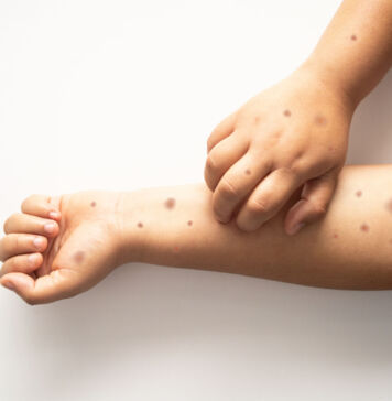 Affenpocken, Pickel oder Pusteln – Wie Sie die feinen Unterschiede erkennen