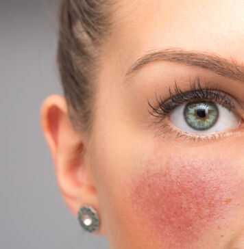 Rosazea – Warum Sonnenschutz gerade für Betroffene wichtig ist